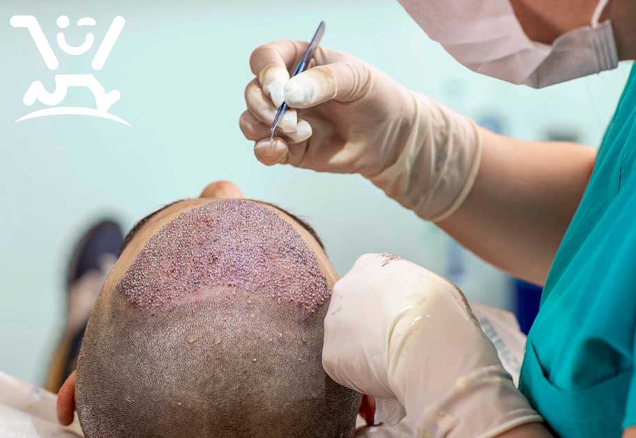 کاشت مو | روش های و معایب کاشت مو