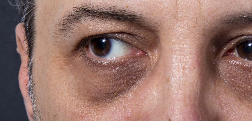سیاهی دور چشم | روش های درمانی