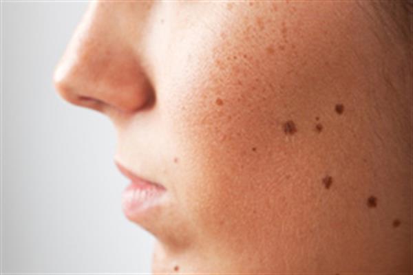 خال روی پوست چیست و چگونه بوجود می آید