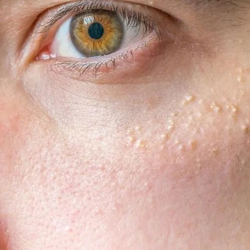 میلیا و نشانه های آن | درمان