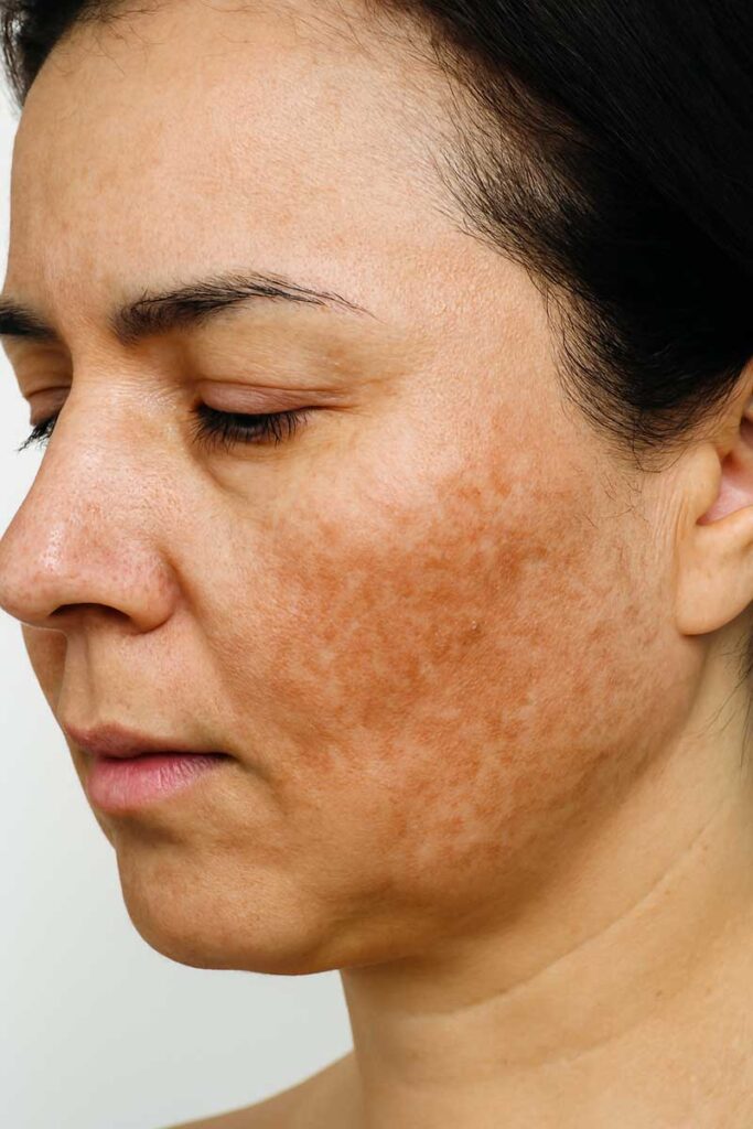 درمان لک های صورت بعد از ۳۰ سالگی